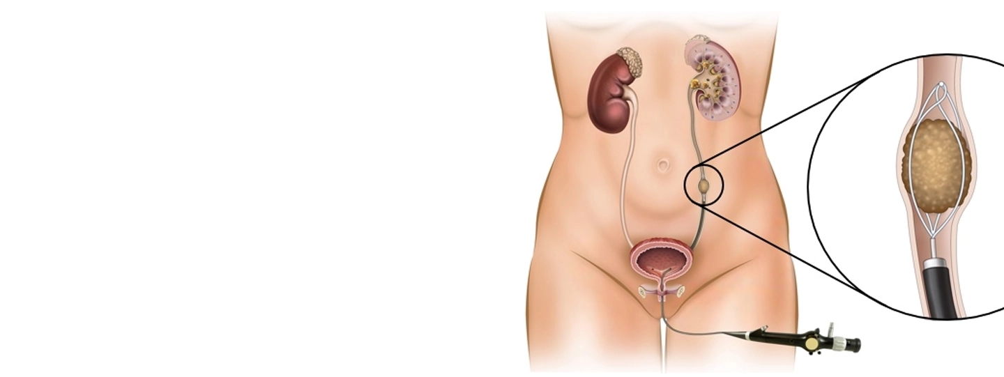 Ureteroscopy (URSL) Cost in Pune: What Affects the Pricing?
